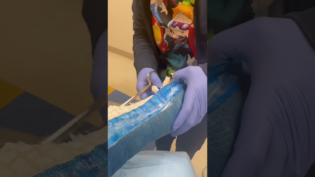 Removing My Cast 🩹
