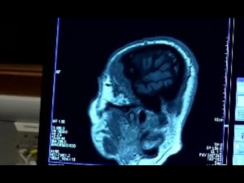 The pitfalls of genetic testing for Alzheimer's