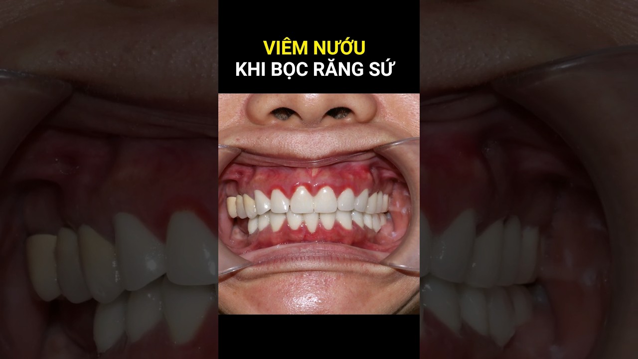 Lưu ý khi bọc răng sứ để tránh viêm nướu 🦷
