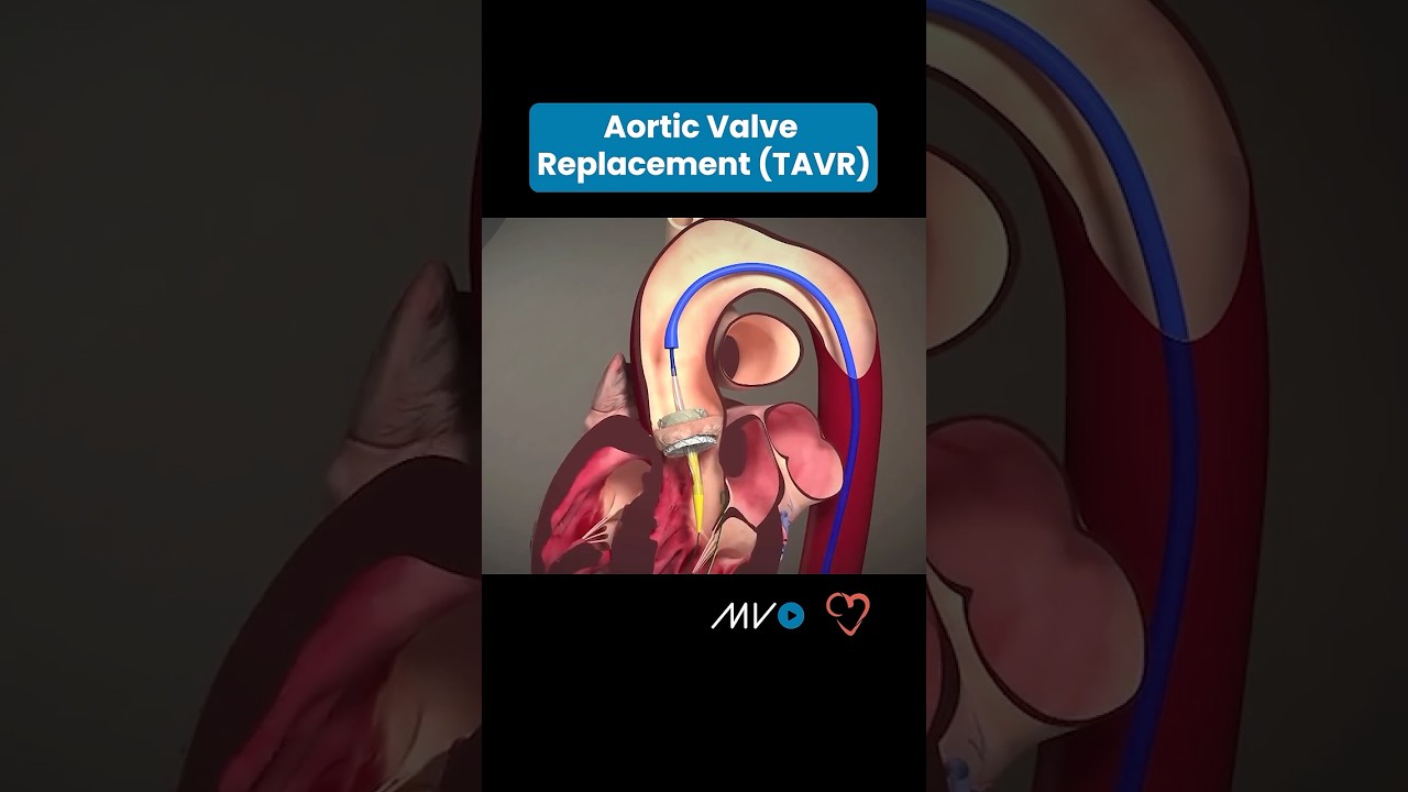 Understanding Transcatheter Aortic Valve Replacement (TAVR) 🫀