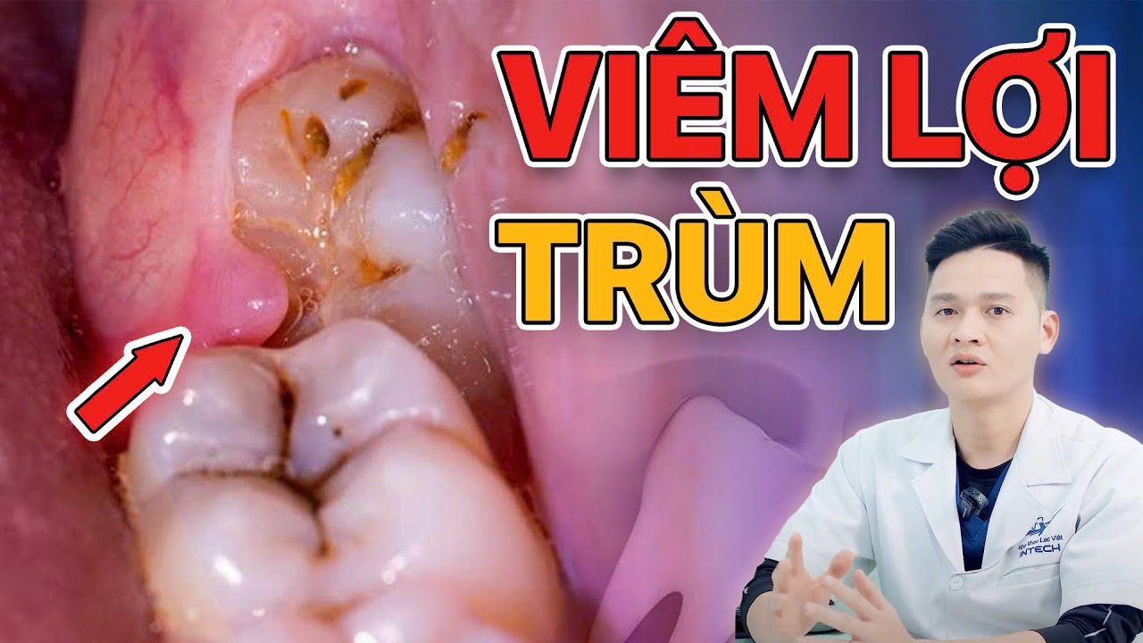 Viêm Lợi Trùm Răng Khôn: Có Tự Hết Được Không? 🦷