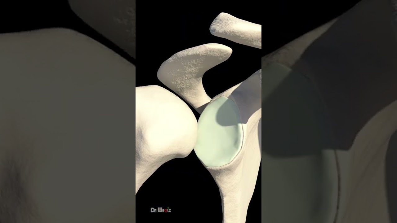 Dislocated Shoulder Explained: Causes, Symptoms & Recovery 🩹