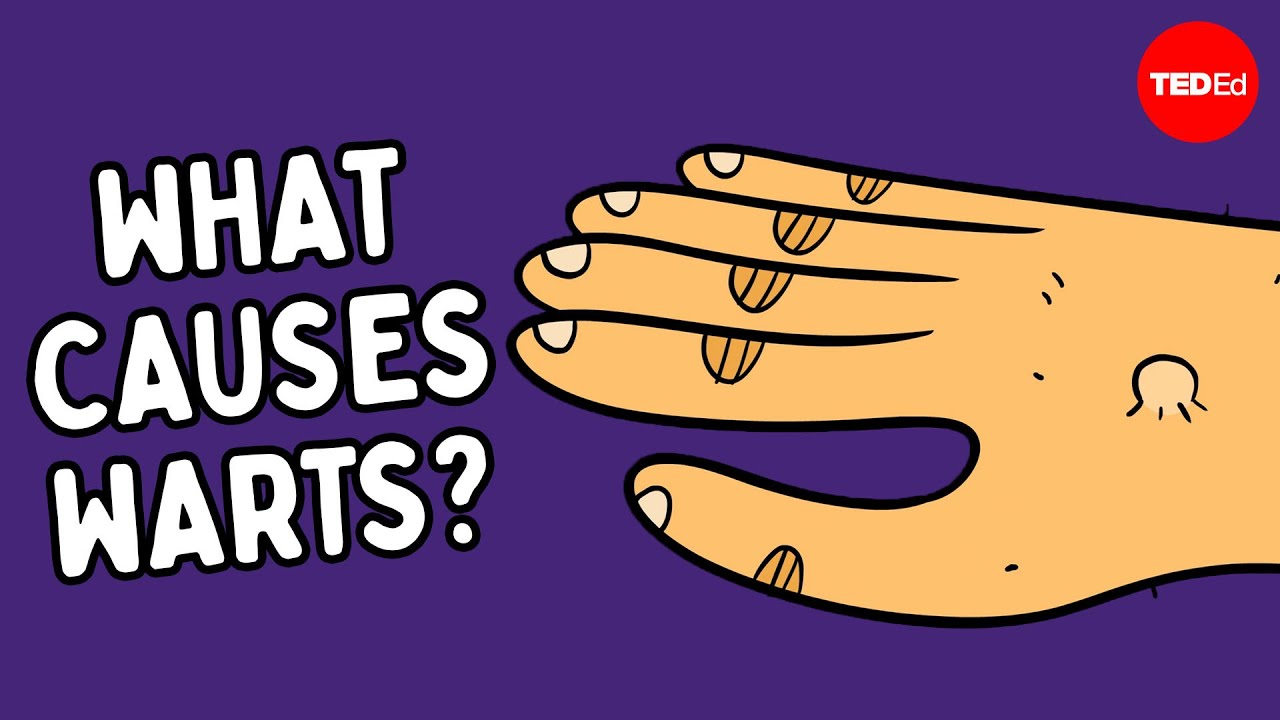 Understanding Warts & How to Remove Them 🧴