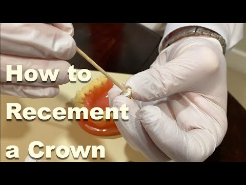 Quick Guide: Temporarily Recement a Crown 🦷