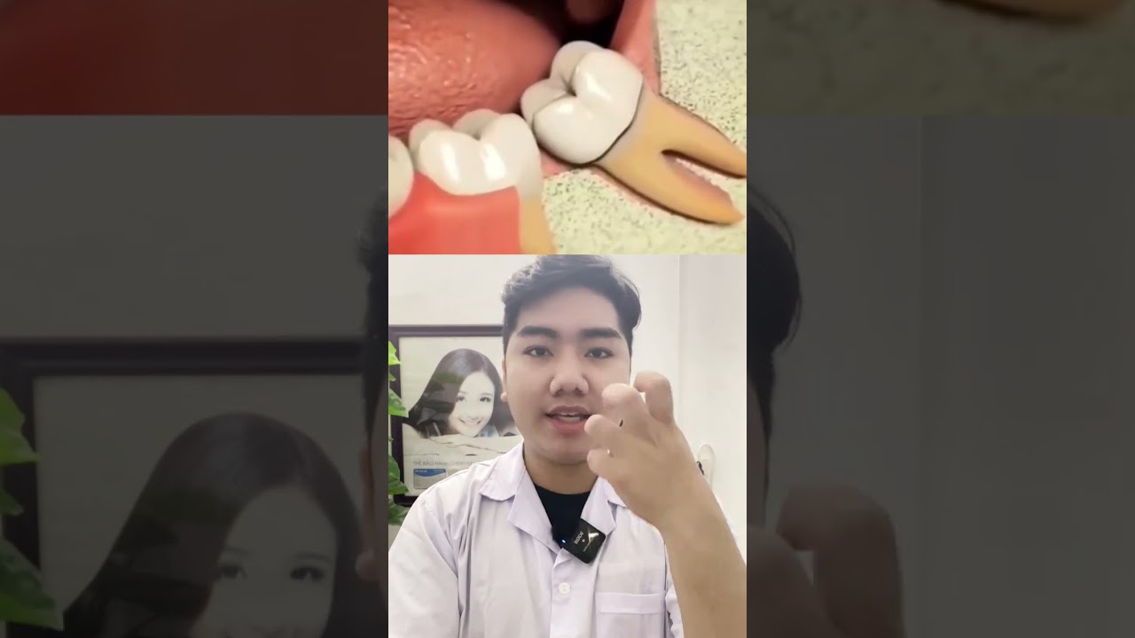 Nguy Hiểm! Nguy cơ Lệch mặt khi nhổ răng khôn #răng #nhakhoa