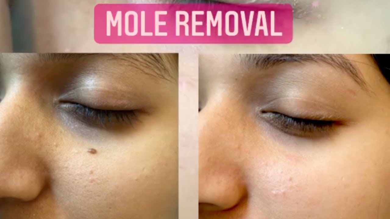 Complete Mole Removal at SkinQure ✨