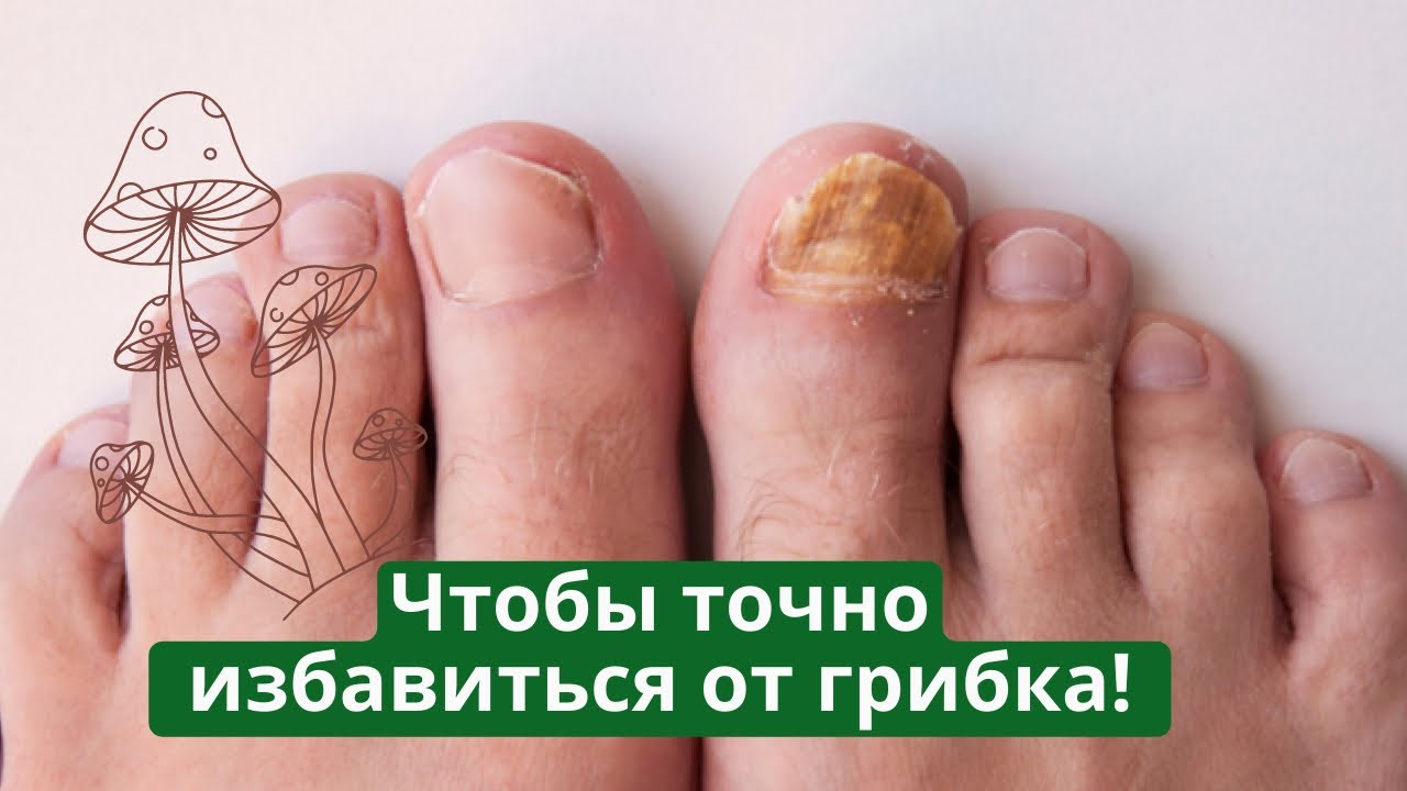 Эффективный спрей для ногтей от грибка 🦶