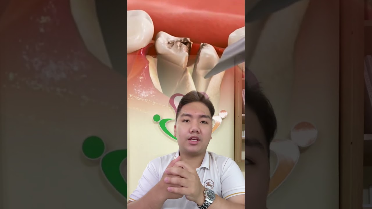 nhổ chân răng - nhổ răng #rang #rang