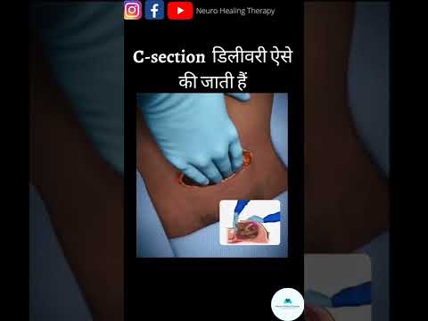 सिजेरियन डिलीवरी कैसे होती हैं #shorts