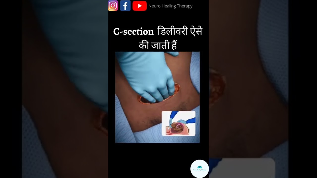 सिजेरियन डिलीवरी का आसान तरीका 💡 | जानिए पूरी प्रक्रिया