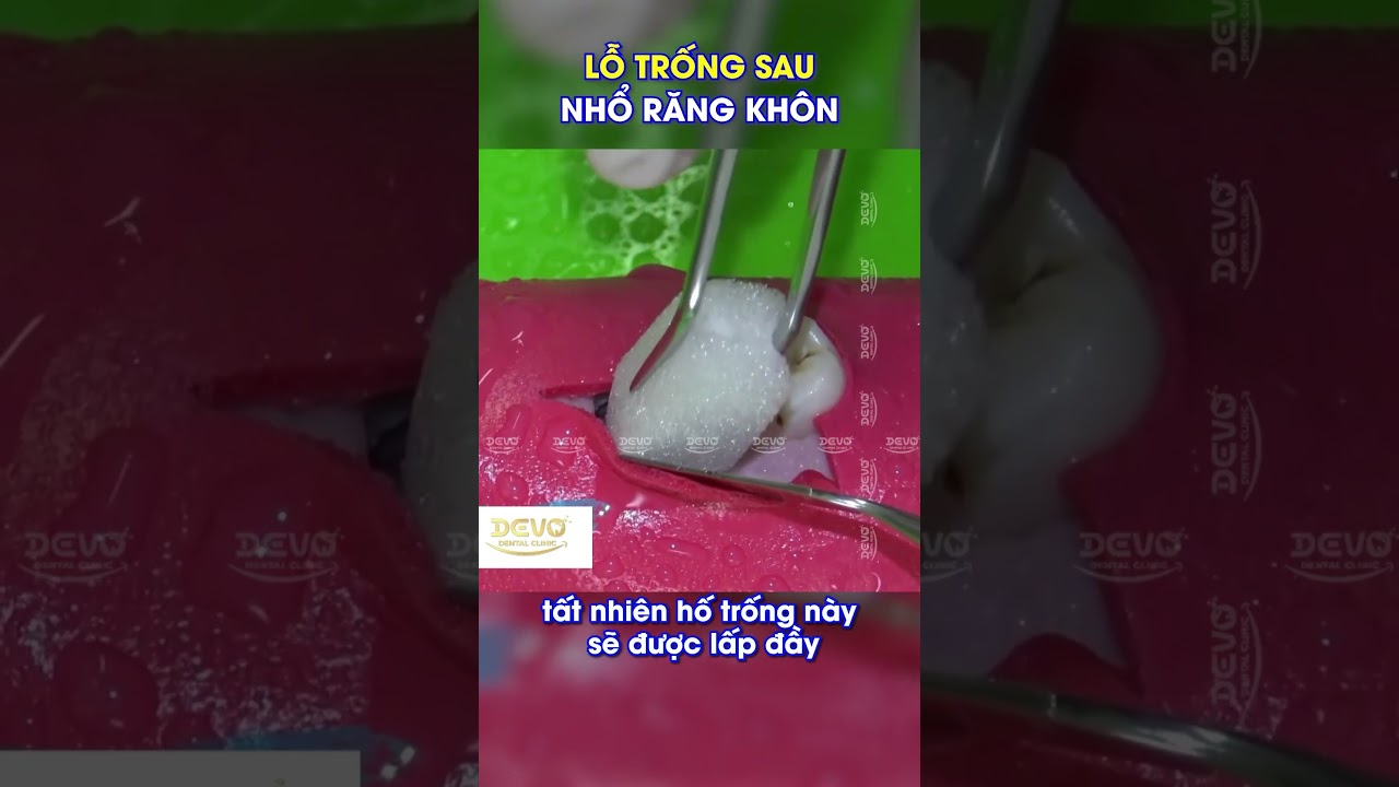 Cách chăm sóc lỗ trống sau nhổ răng khôn 🦷