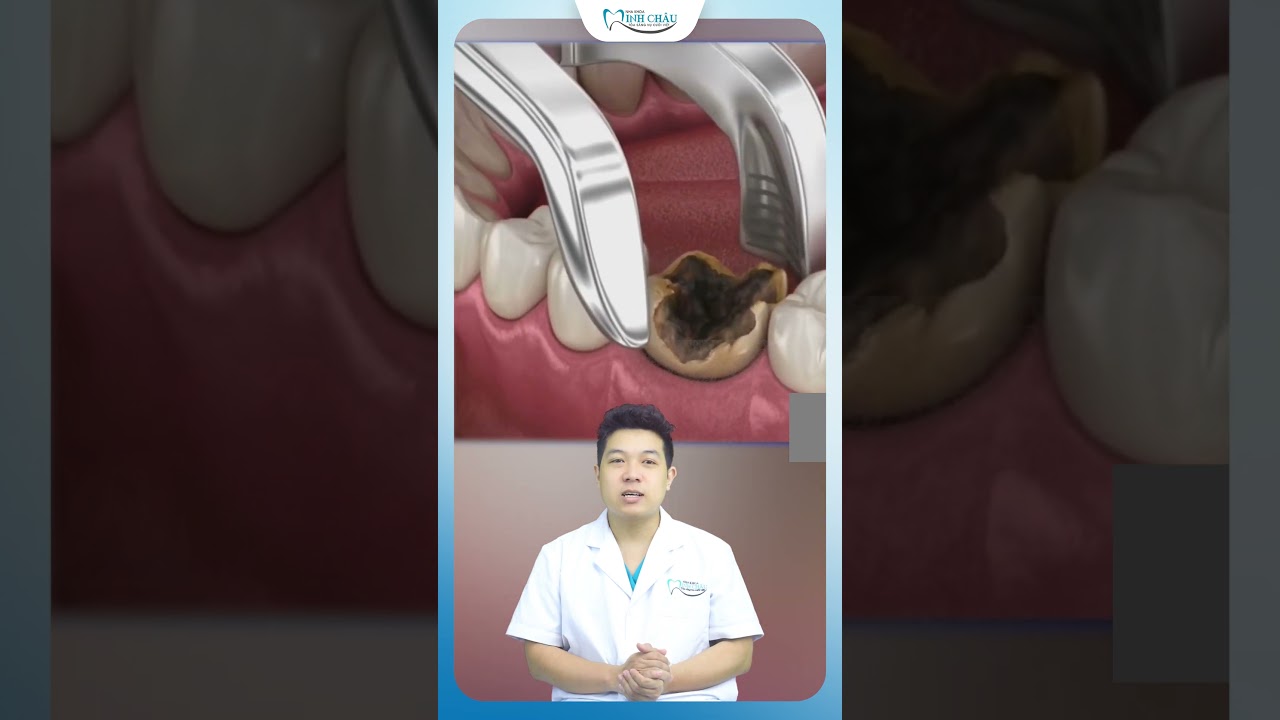 Nhổ Răng Số 6 Hàm Dưới Bị Sâu Hỏng | Nha Khoa Minh Châu