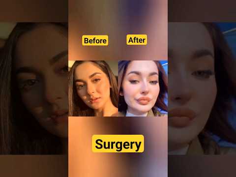 Pakistan actress before and after surgery #surgery #mahirakhan #pakistaniactresses #durefishan