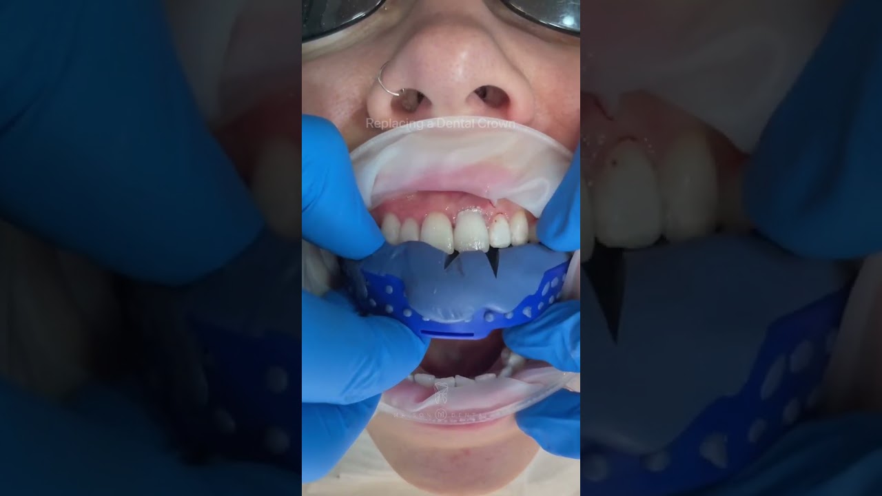How to Replace a Dental Crown 🦷