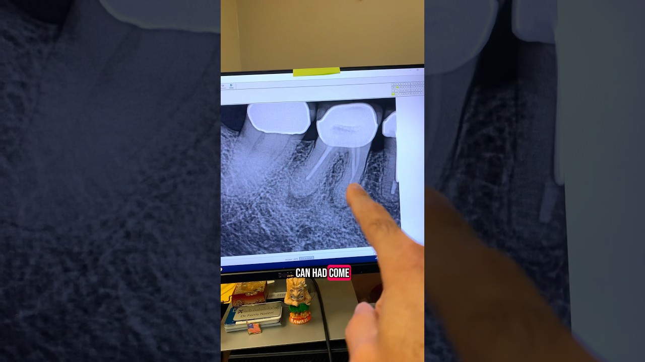 You can’t do root canals like this & expect success! Endo retx of tooth #30. #endodontics #dentists