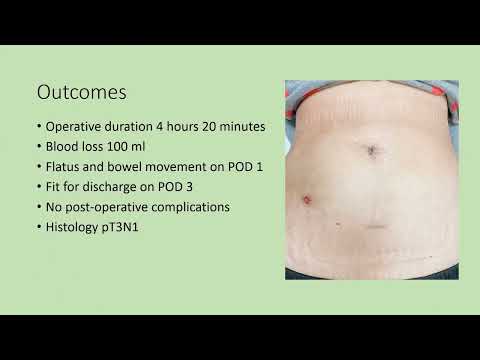 3-port laparoscopic D3 right hemicolectomy with transvaginal natural orifice specimen extraction
