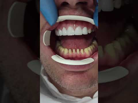 Zirconium Crowns: Before & After at Venedik Dental