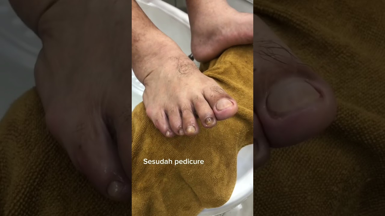 KUKU TEBAL & TUA? Perawatan Pedicure & Kuku Sehat π
