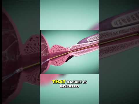 Prostate Treatment: Revolutionary ITIND Procedure