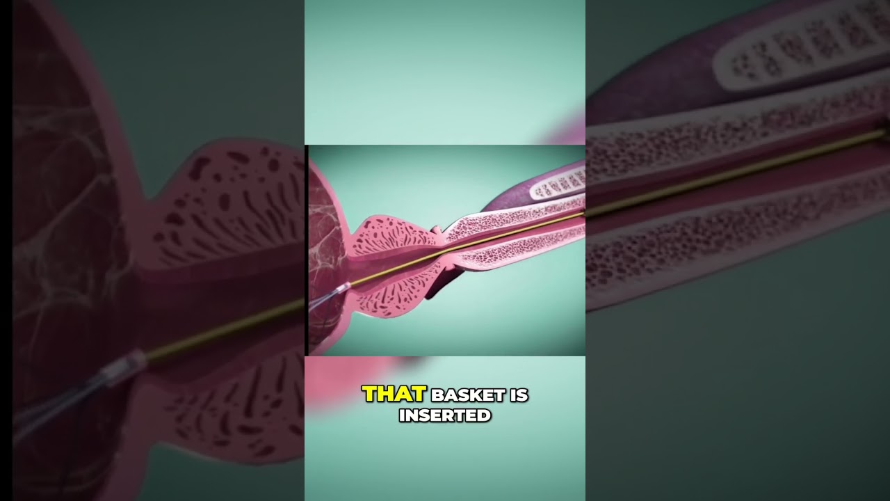 Revolutionary ITIND Procedure for Prostate Treatment ๐