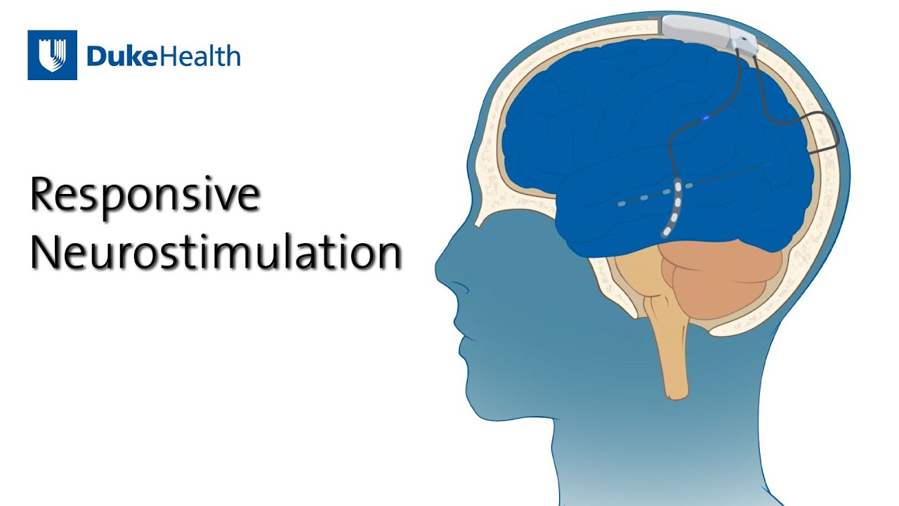 Responsive Neurostimulation (RNS) for Epilepsy | Duke Health