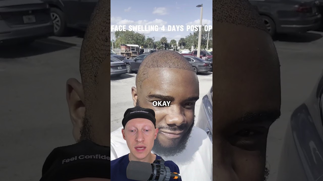 Share Your Thoughts on This Hair Transplant Result ✂️