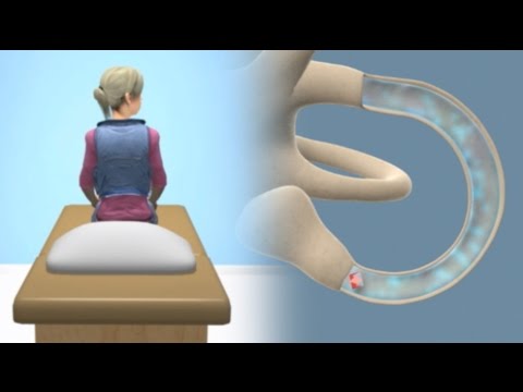Epley Maneuver for BPPV Vertigo 🌀