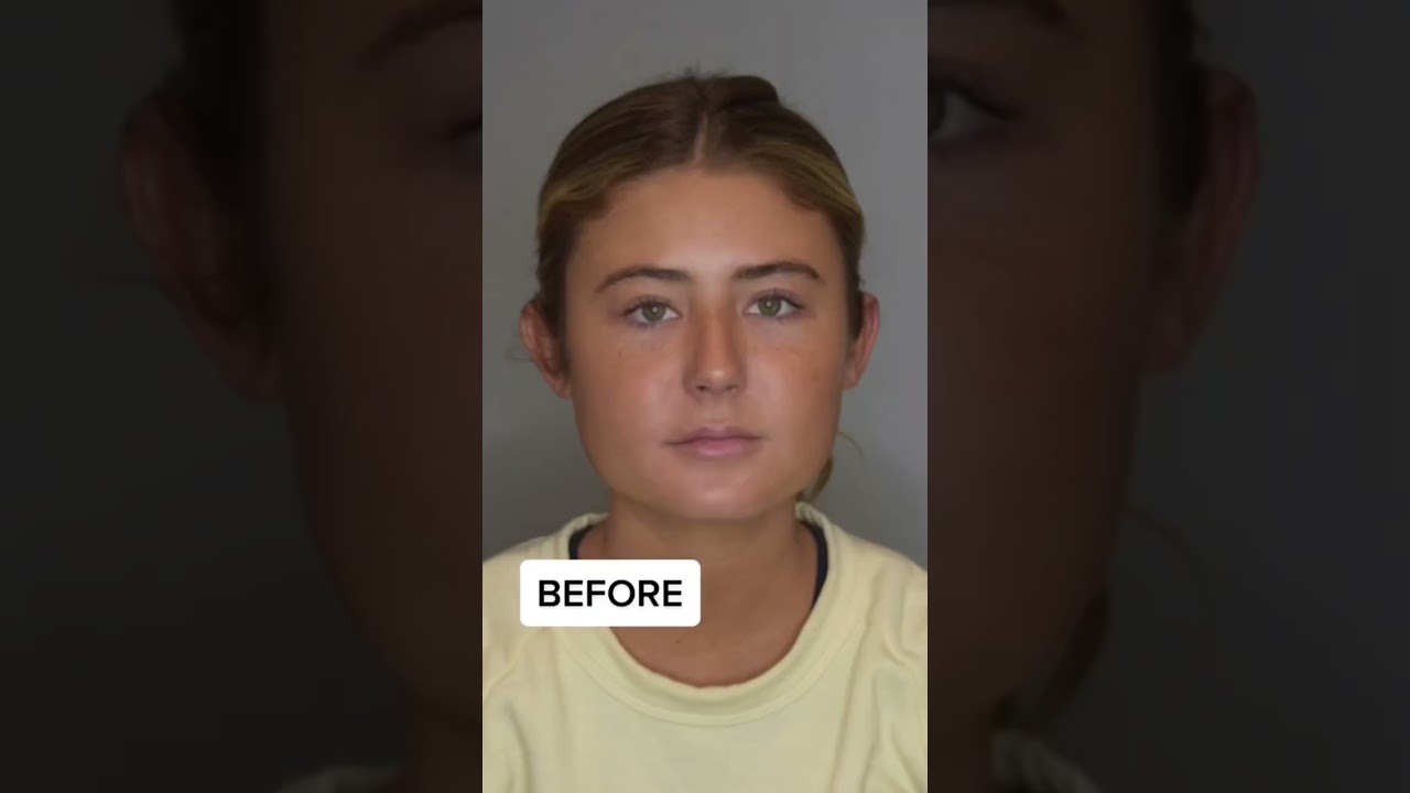 Stunning Buccal Fat Removal Transformations: Before & After ✨