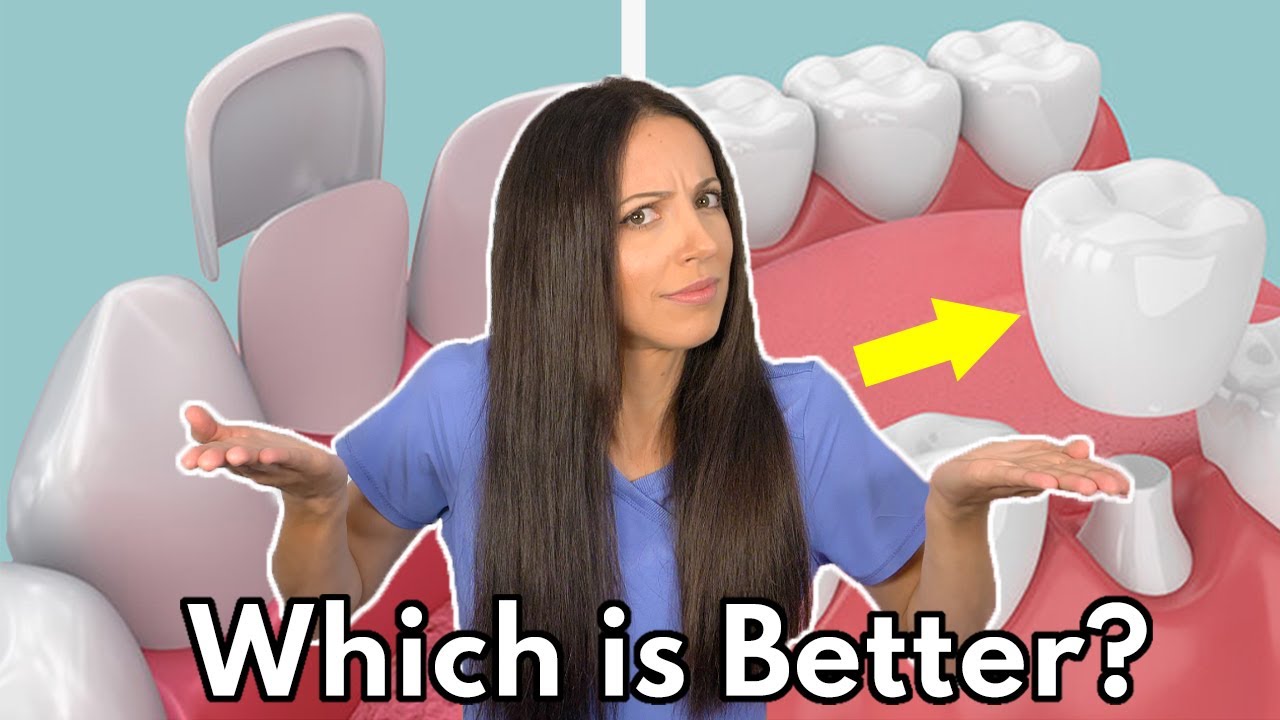 Veneers vs. Crowns: Which Is Better? 🦷