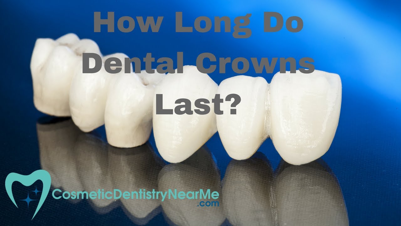 Dental Crowns: How Long Do They Last? 🦷