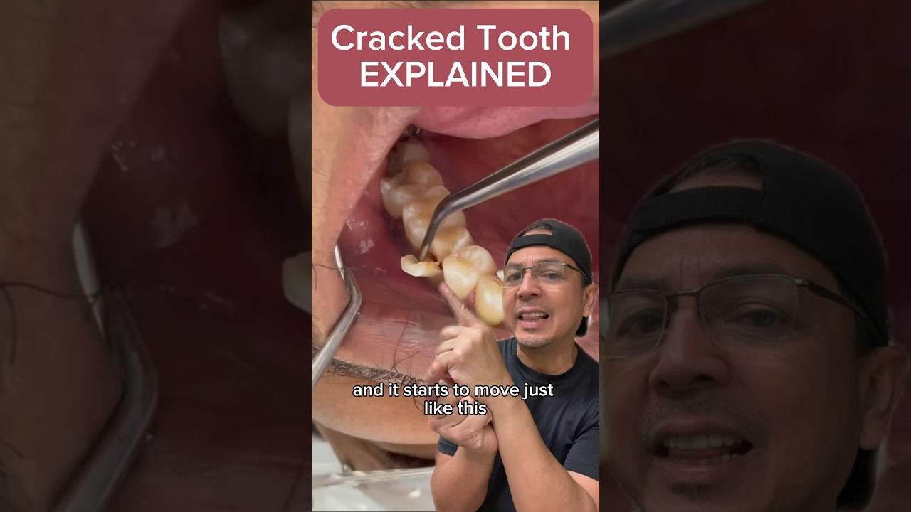 Cracked Tooth? Here's What to Do 🦷