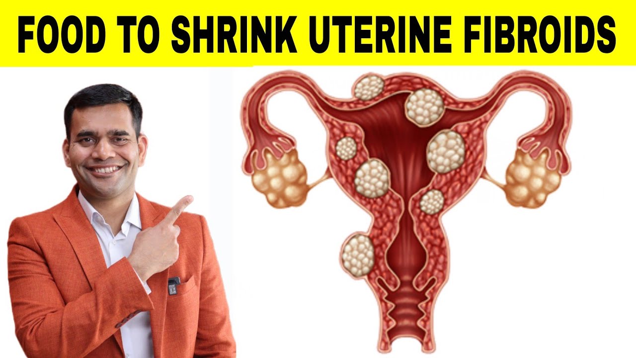 Foods to Shrink Uterine Fibroids 🥗 - Dr. Vivek Joshi