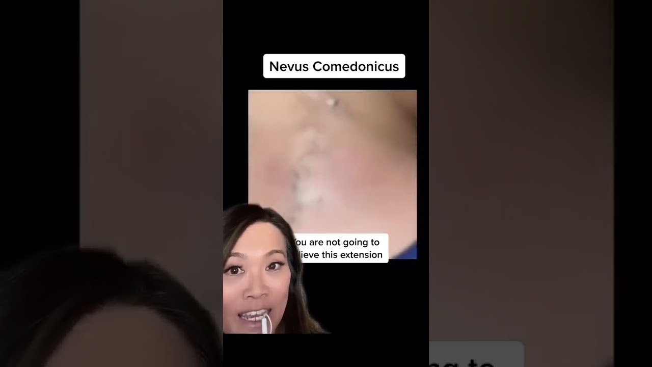 How do you avoid getting these blackheads and whiteheads? π