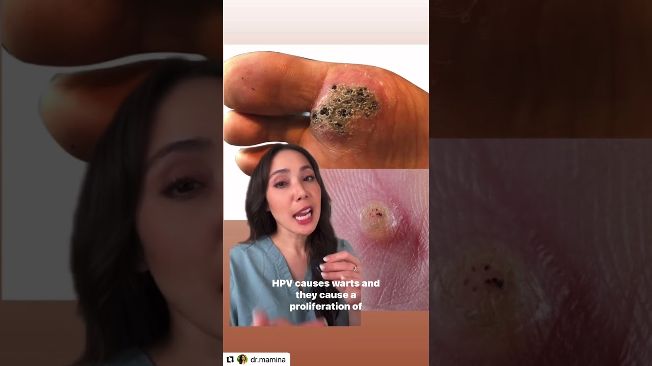 Do Warts Have Seeds? Debunking the Myth