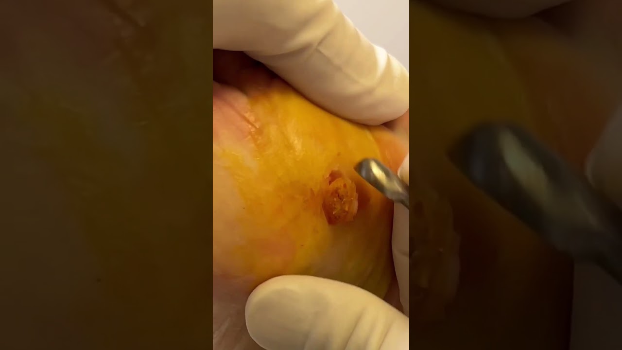 Foot Enthusiasts: Plantar Wart Removal Surgery 👣