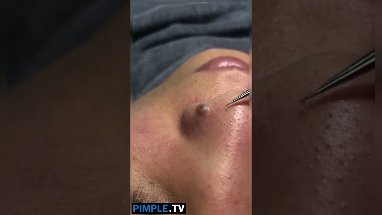 Big Blackhead & Cystic Acne Popping | Skin Care Tips