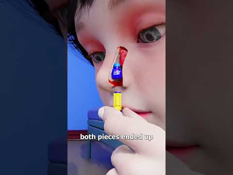 Lego Stuck In Nose For 26 Years 😨