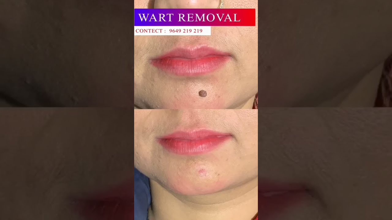 Why We Love Wart Removal Treatments ✨