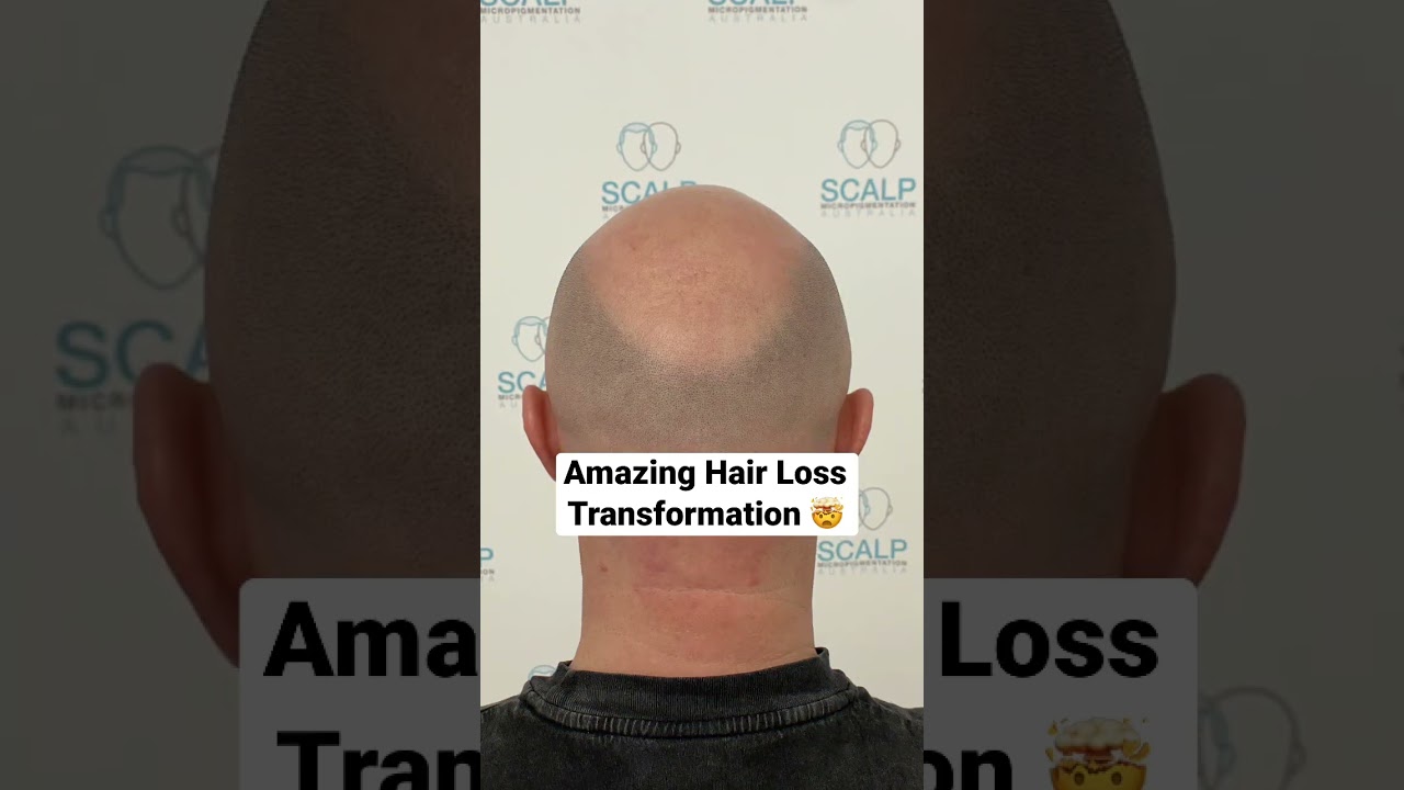 Top Hair Loss Solution for Instant Results 💇‍♂️