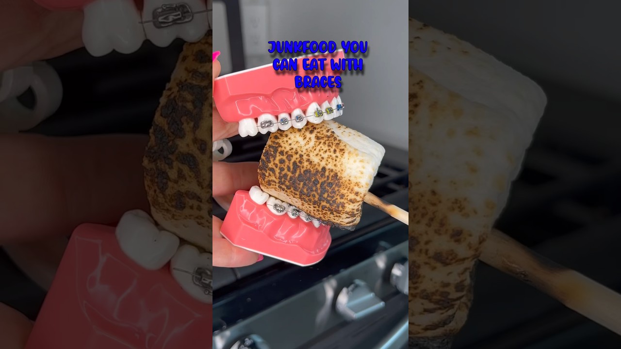 Brace-Friendly Junk Food Tips π