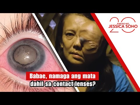 Babae, namaga ang mata dahil sa contact lenses? | Kapuso Mo, Jessica Soho