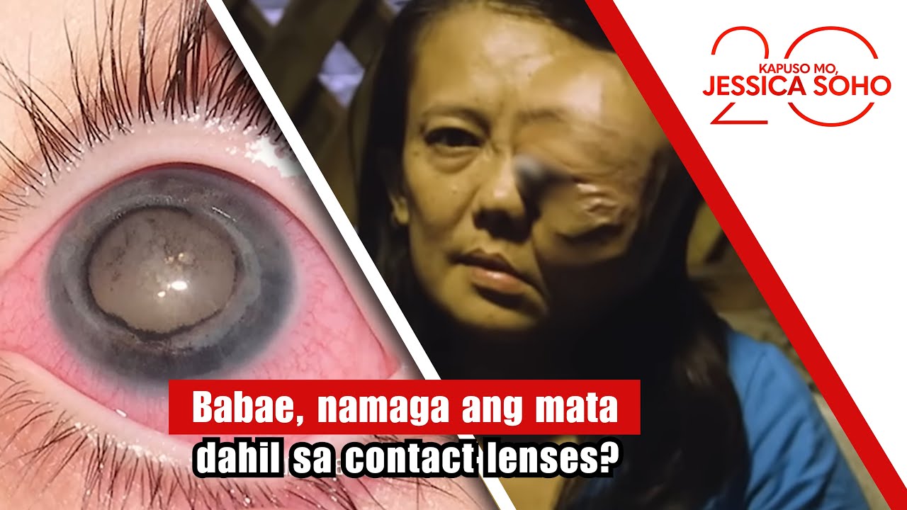 Namaga at Namula ang Mata ni Ritchelle Dahil sa Contact Lenses? | Kapuso Mo, Jessica Soho ποΈ