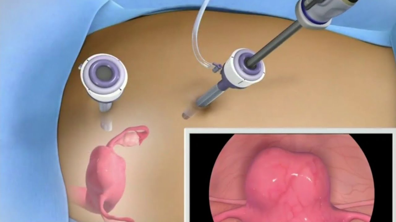 Innovative Methods to Shrink Fibroids 🌸