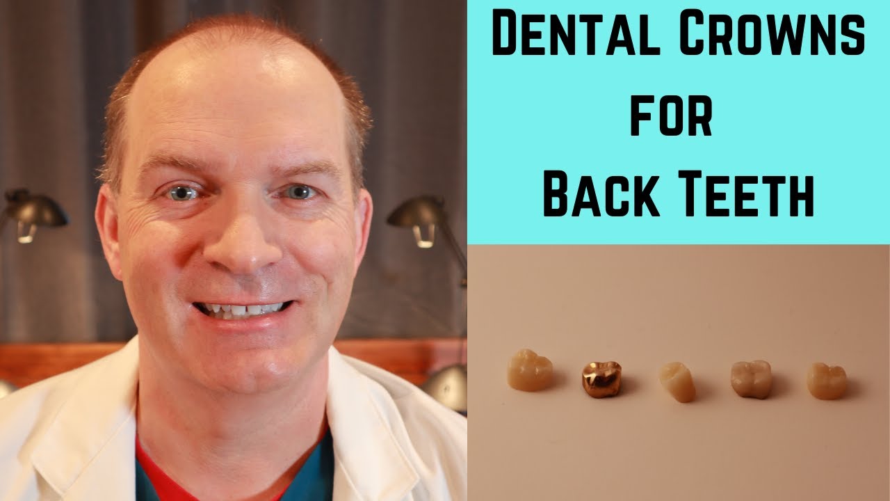 Back Tooth Dental Crown Options 🦷