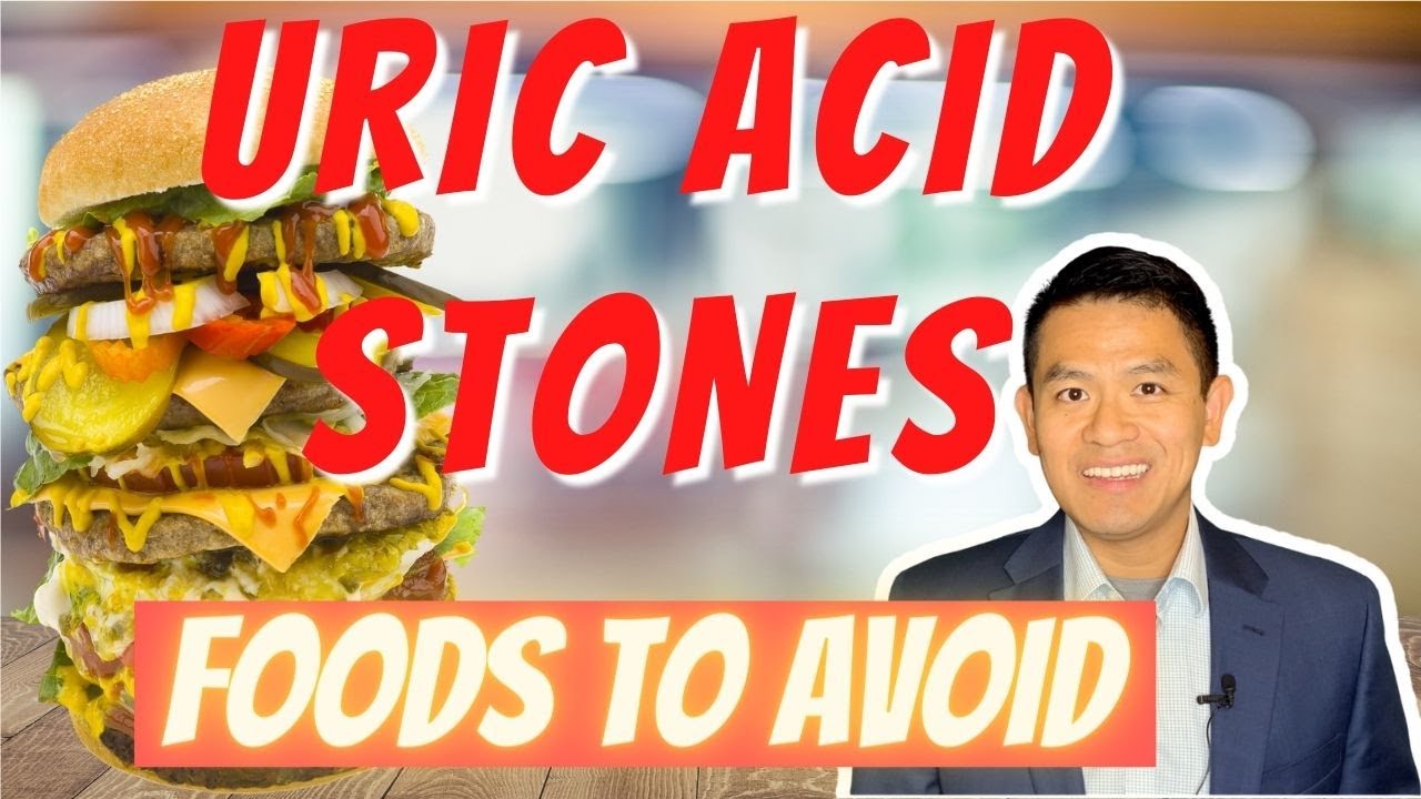Prevent Uric Acid Kidney Stones: 6 Foods to Avoid 🥗