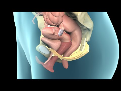 Pelvic Prolapse Explained | Nucleus Health 🩺
