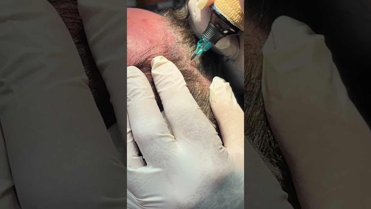 Scalp Micropigmentation at Jernigans 💇♂️