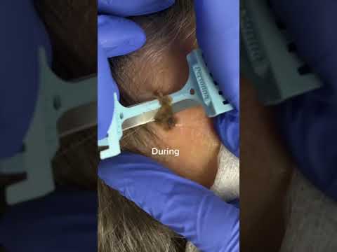 Quick Mole Removal Tips 🩺