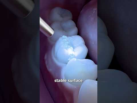 How Dentists Repair A Split Tooth ๐ฌ