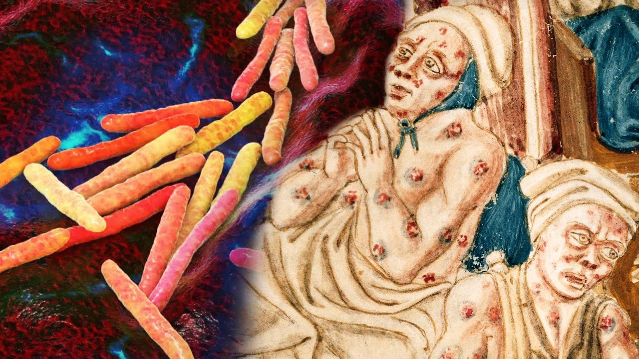 Leprosy Rise in Florida: Should You Be Concerned? 🦠